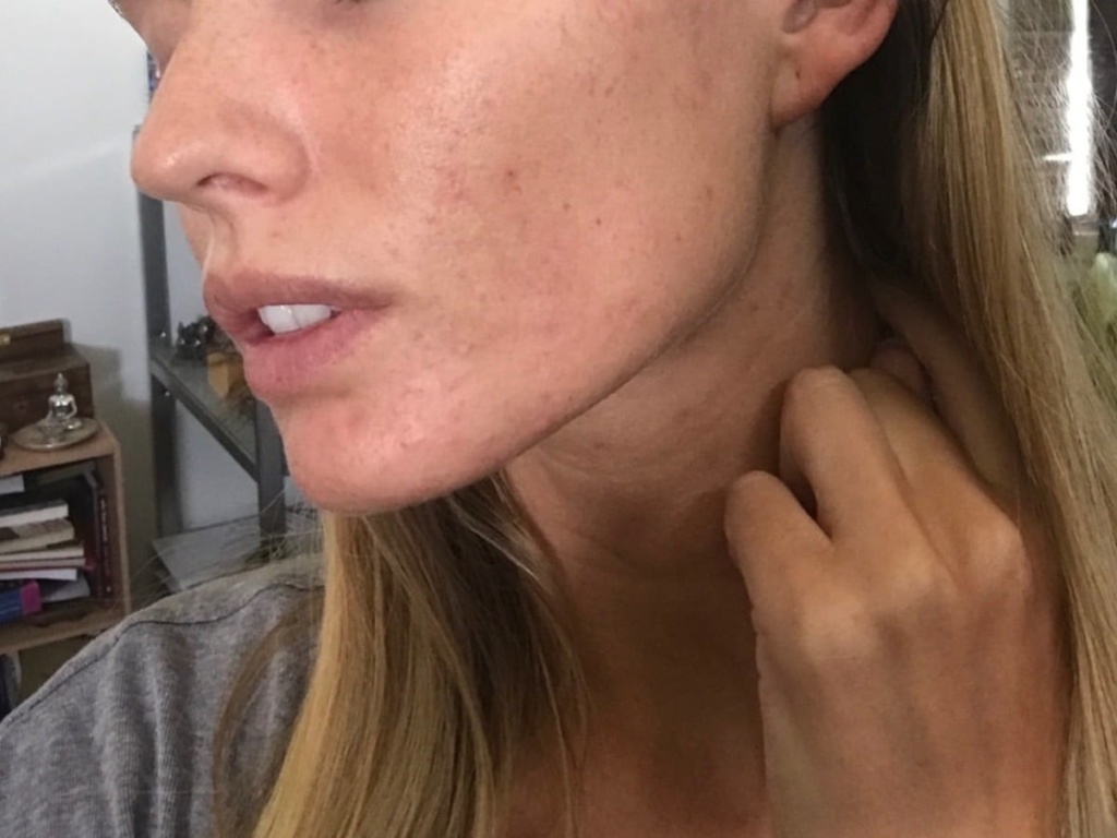 Cystic Acne After