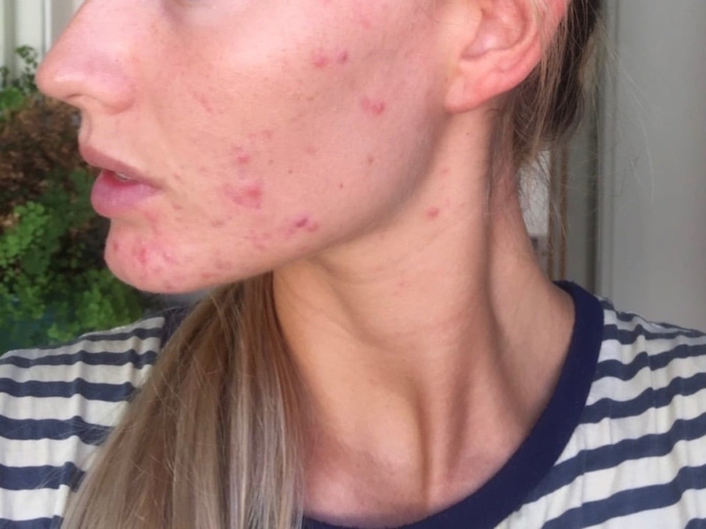 Cystic Acne Midway