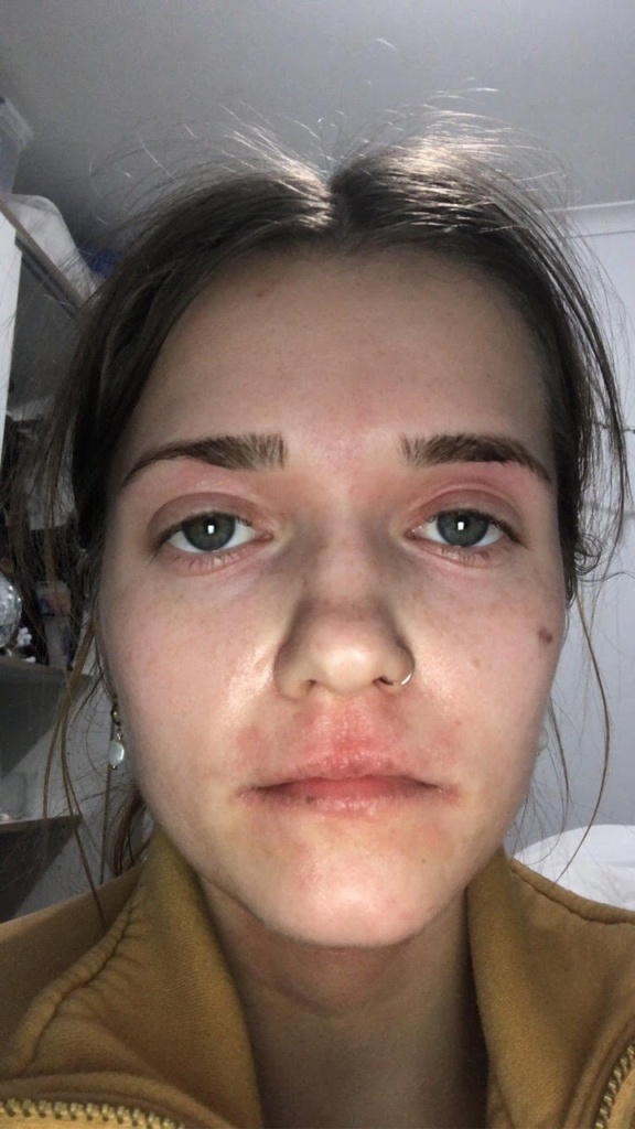 Facial Eczema Before